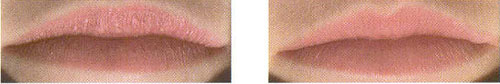 LipTox Before & After Photos